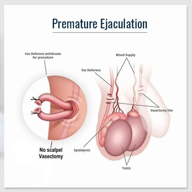 Premature Ejaculation and Causes behind It